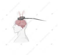 C&aacute;c kỹ thuật điều trị kh&ocirc;ng x&acirc;m lấn như k&iacute;ch th&iacute;ch từ trường xuy&ecirc;n sọ, k&iacute;ch th&iacute;ch điện